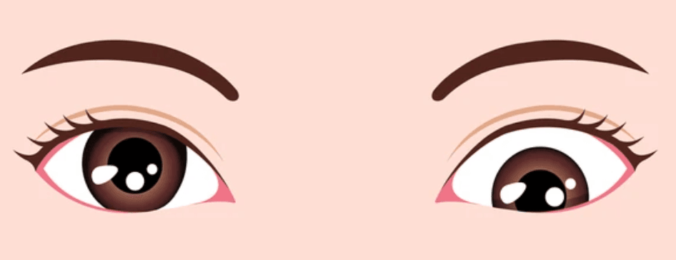 Strabismus