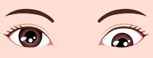 Strabismus