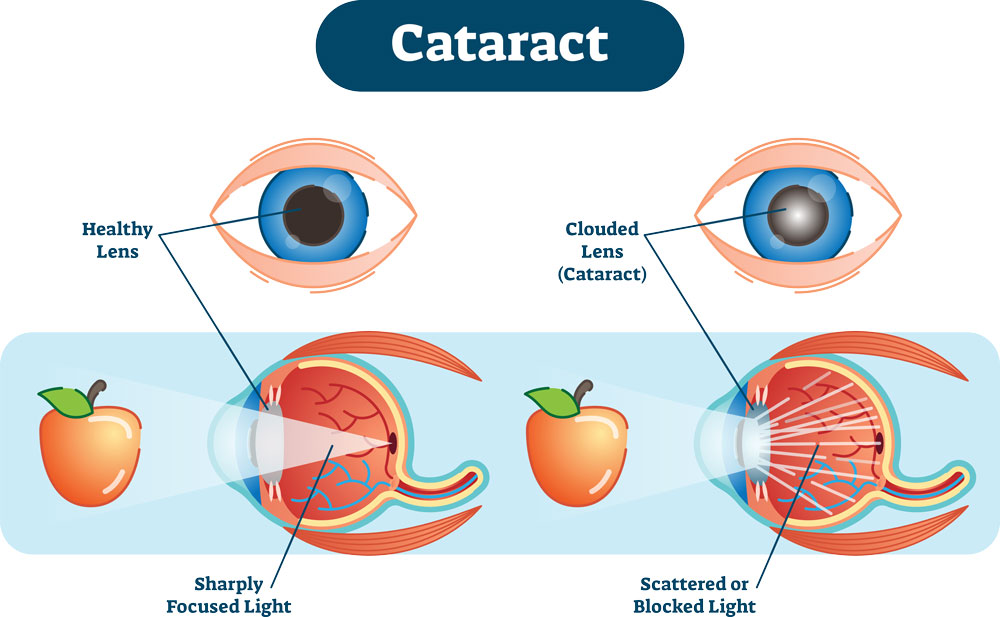 Cataract Compared to Healthy Eye